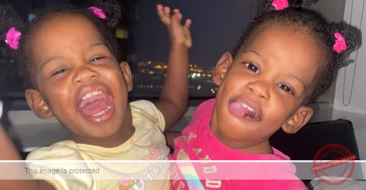 Conjoined Twins Azaria and Azora Elson Successfully Separated in Saudi Arabia Surgery