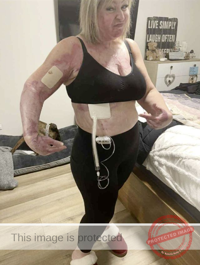 After a Fireplace Explosion, One Australian Mother’s Journey From Survival to Strength